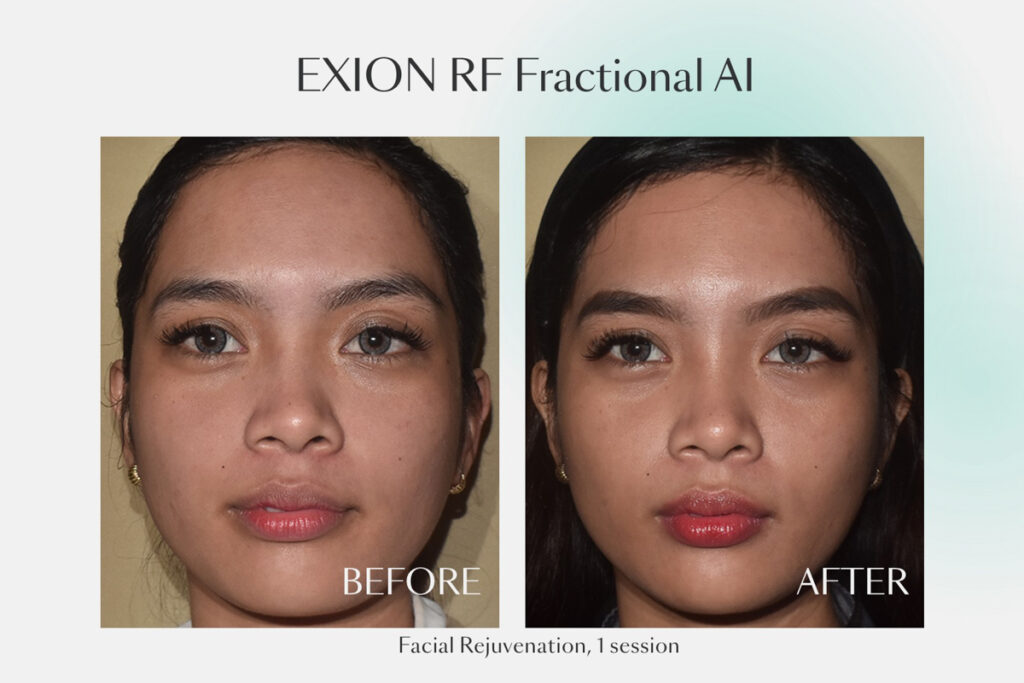 Before and after 1 session of EXION RF Fractional AI for facial rejuvenation