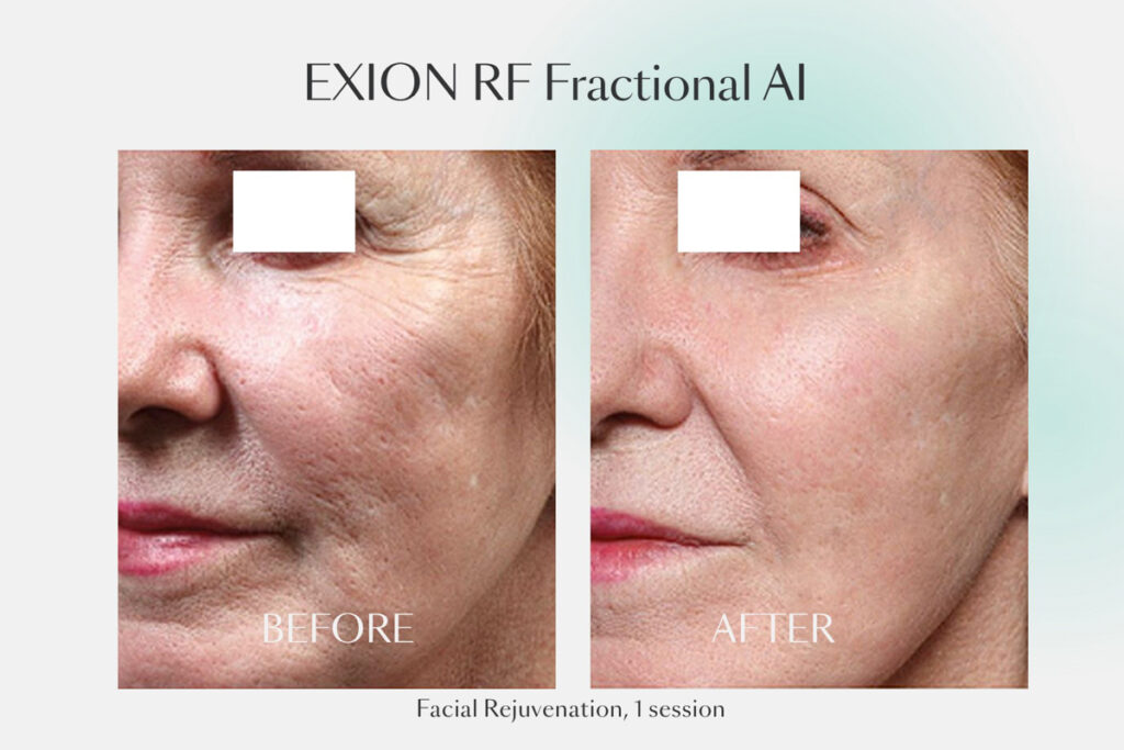 Before and after 1 session of EXION RF Fractional AI for facial rejuvenation