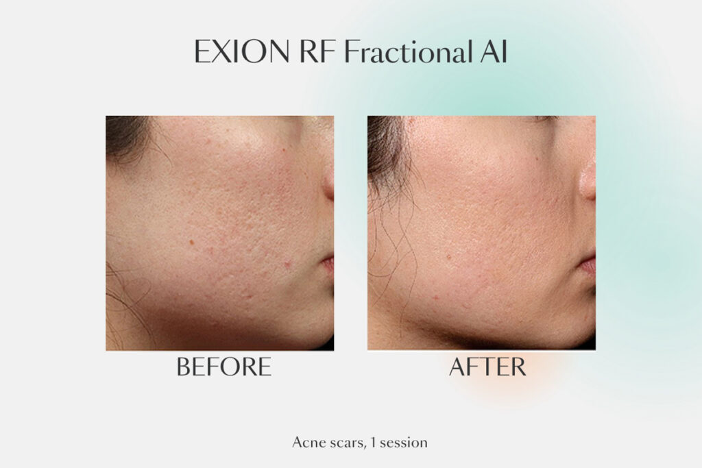 Before and after 1 session of EXION RF Fractional AI treating acne scars