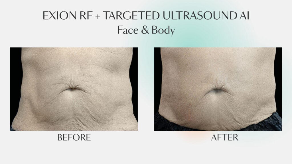 Before and after sessions of EXION RF + TARGETED ULTRASOUND AI for face & body