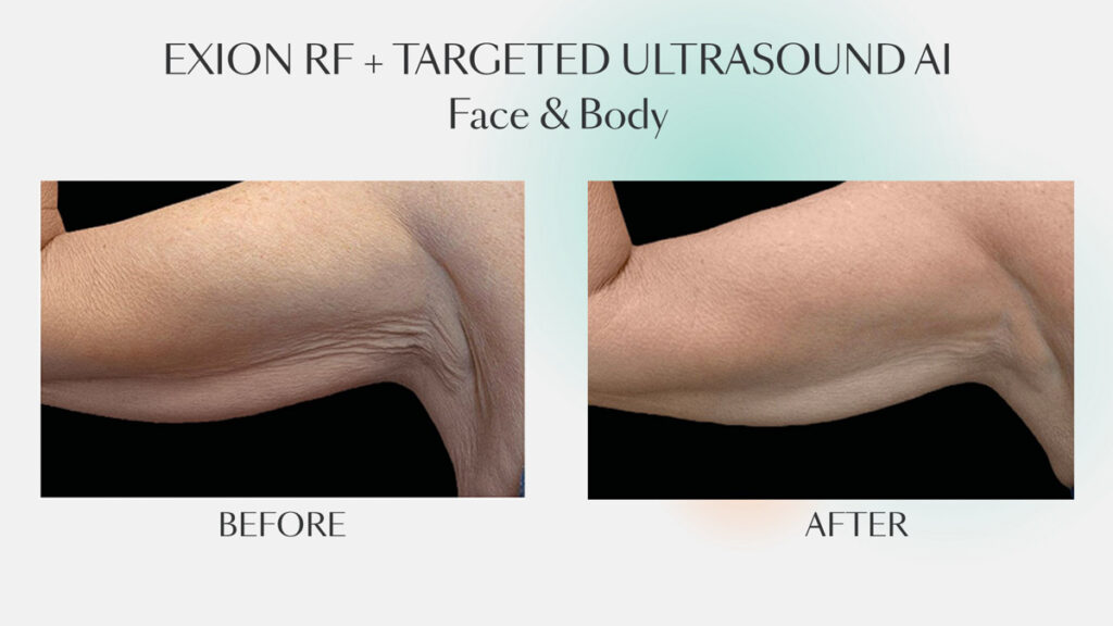 Before and after sessions of EXION RF + TARGETED ULTRASOUND AI for face & body