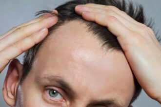 Hair Loss in Men