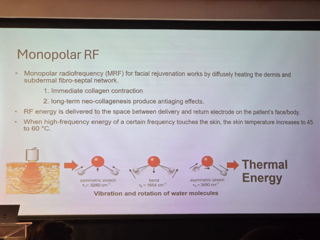 Xerf xperience 2026 monopolar RF treatment