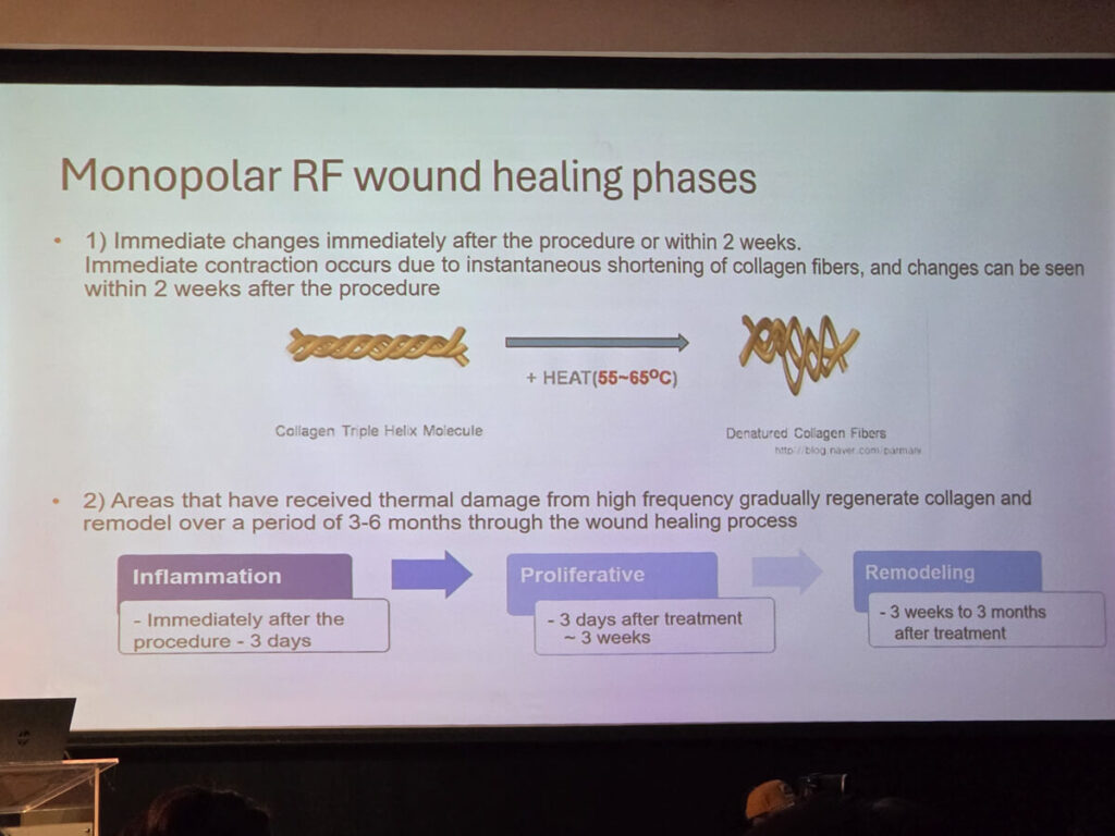 Xerf xperience 2026 monopolar RF treatment